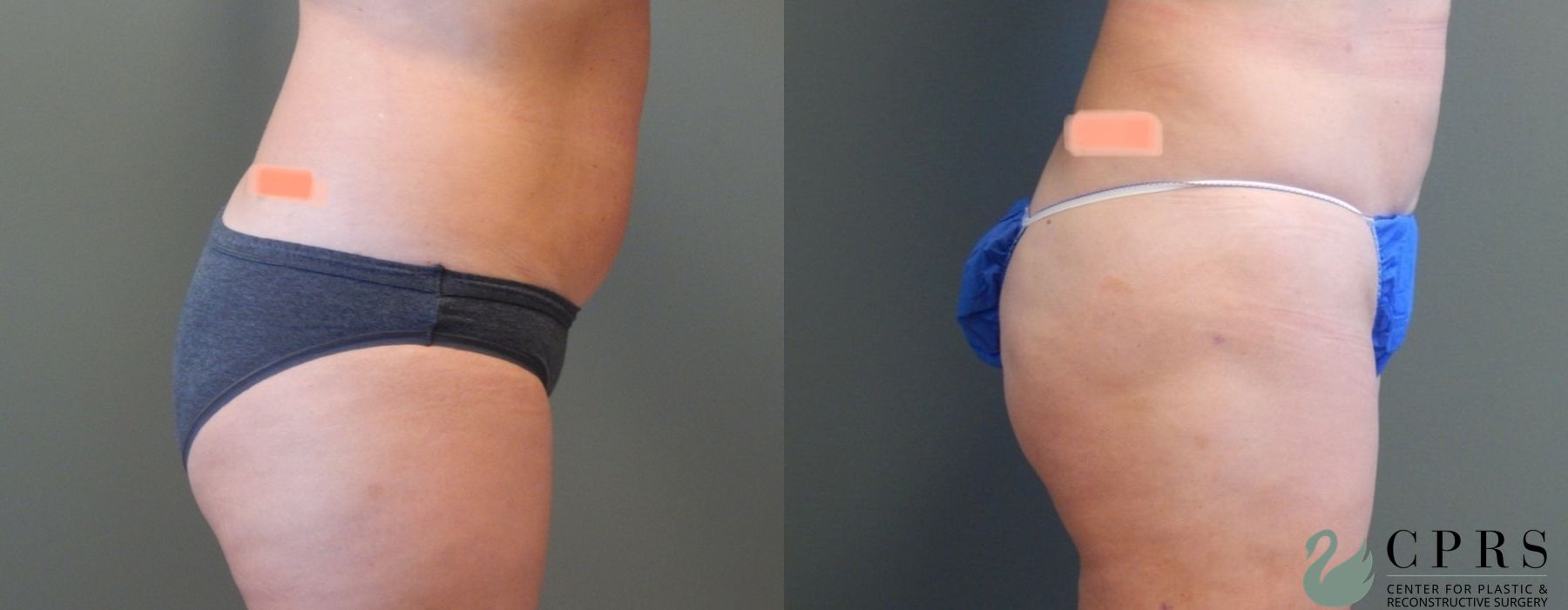 Liposuction - Thumbnail 2