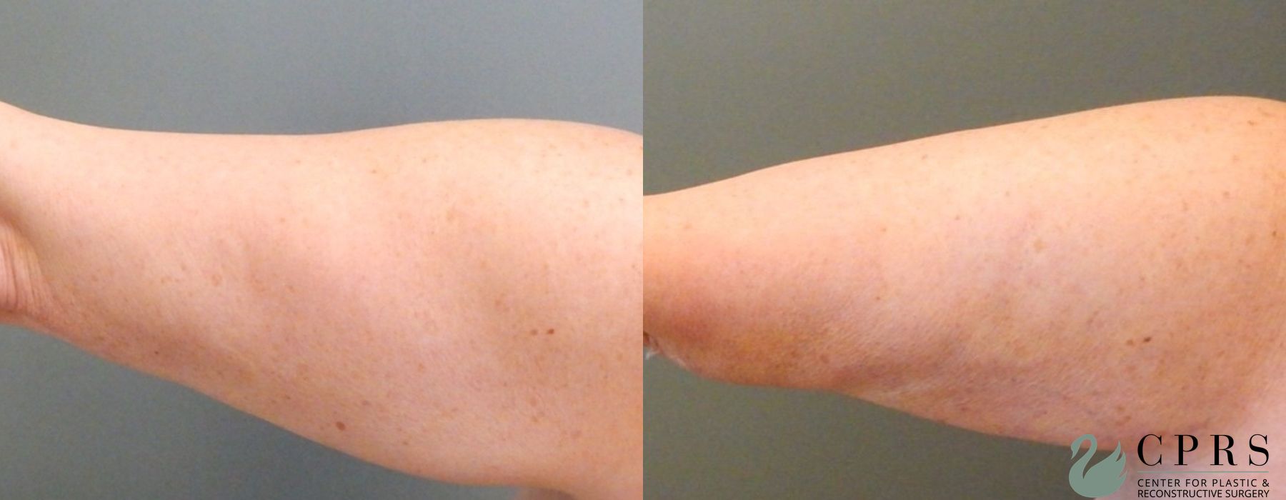 Before and after Liposuction case 19058