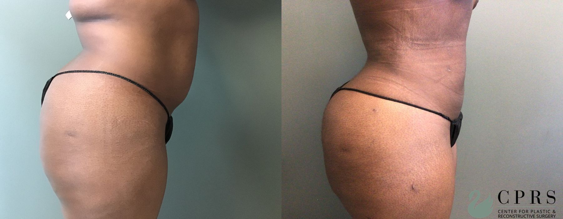 Before and after Liposuction case 19065 - Angle 2