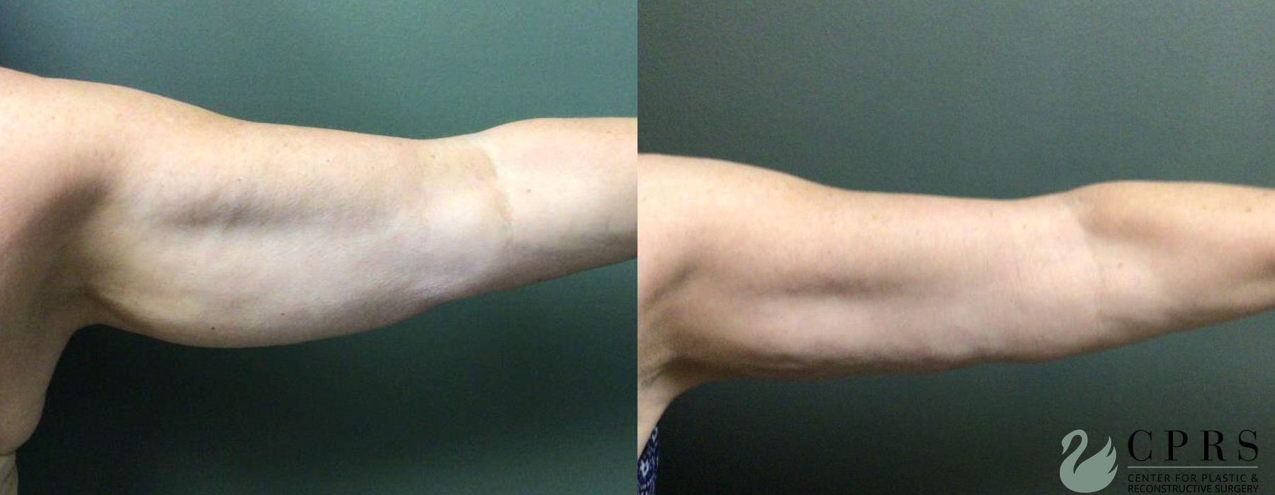 Before and after Liposuction case 19101 - Angle 2