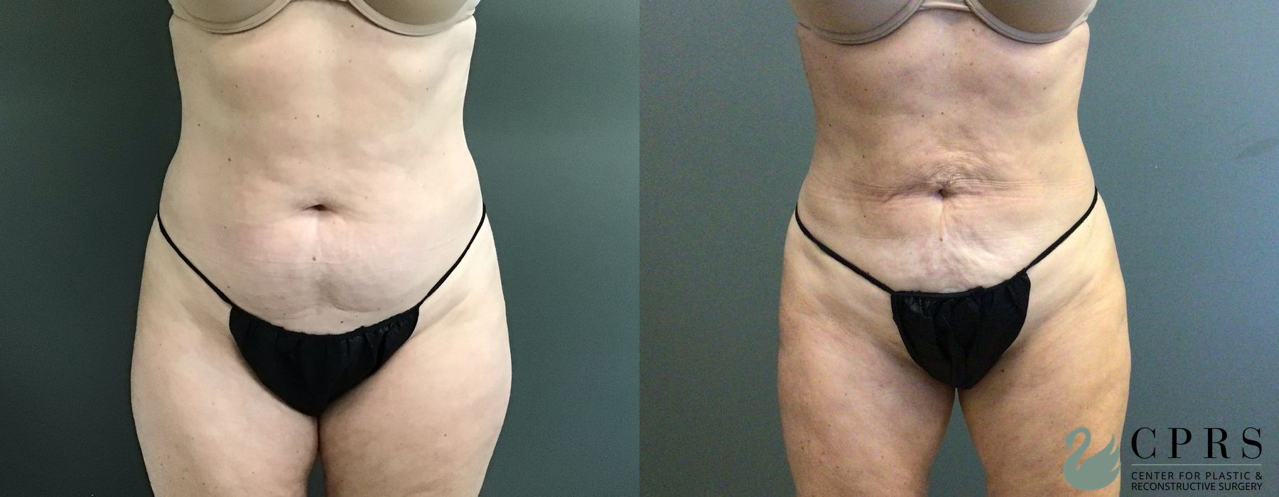 Before and after Liposuction case 33065