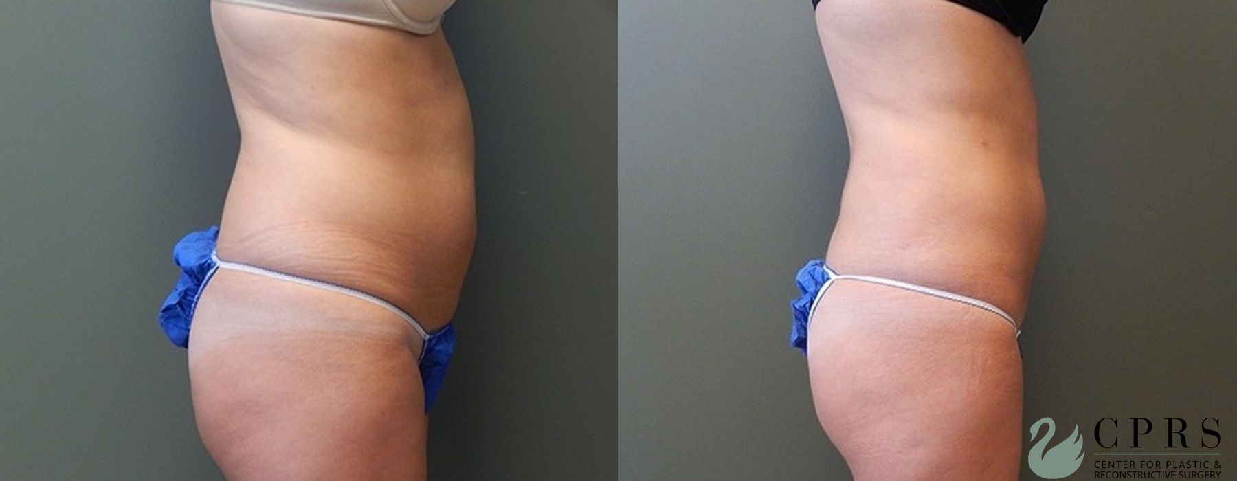 Liposuction - Thumbnail 4