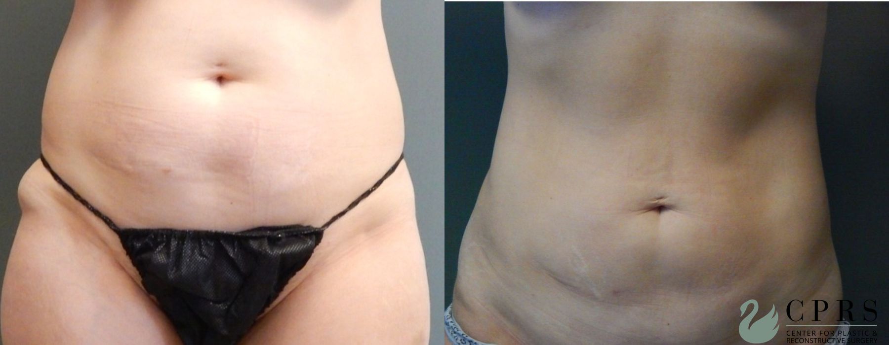 Before and after Liposuction case 19093
