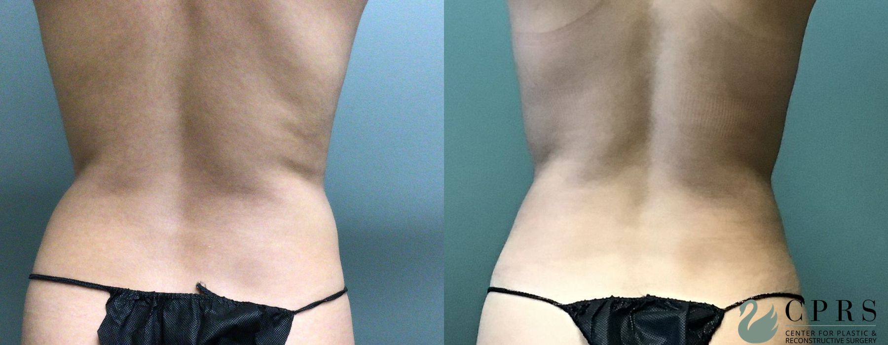 Liposuction - Thumbnail 3