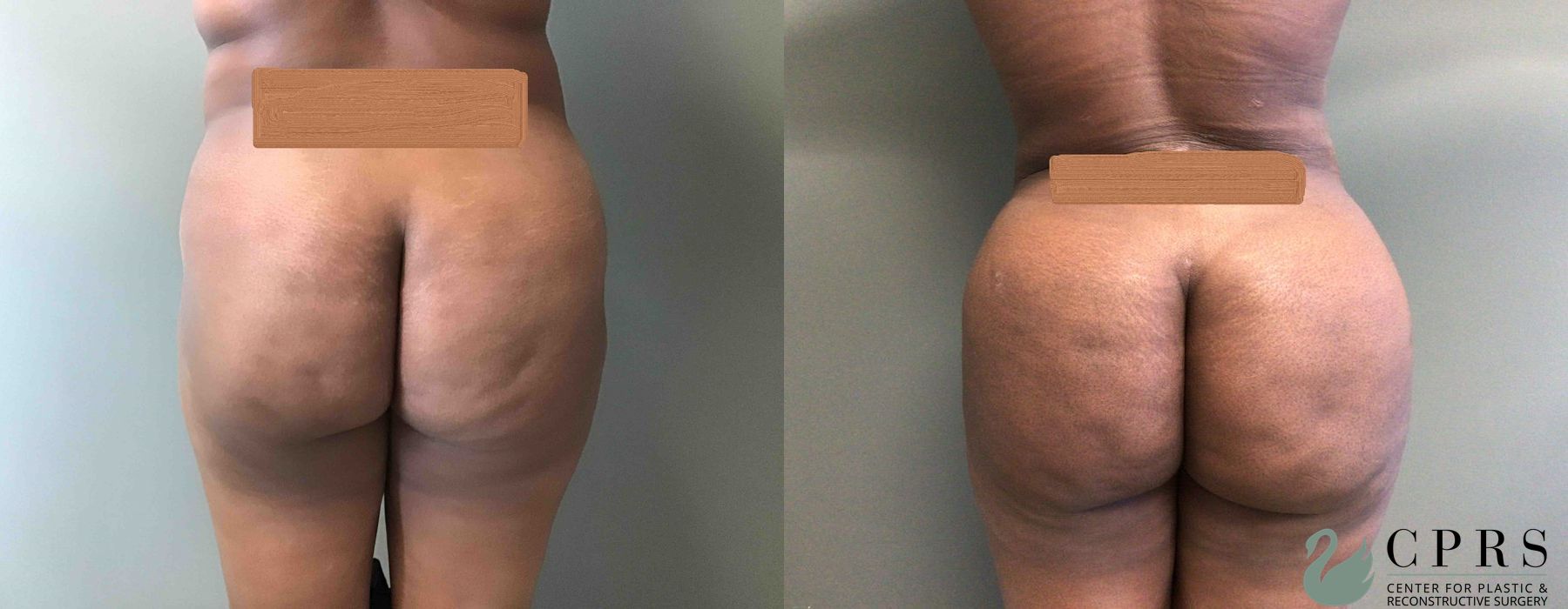 Before and after Liposuction case 19065 - Angle 3