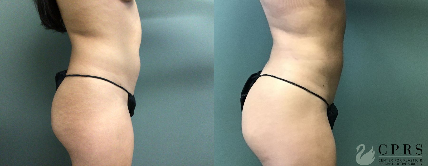 Liposuction - Thumbnail 2