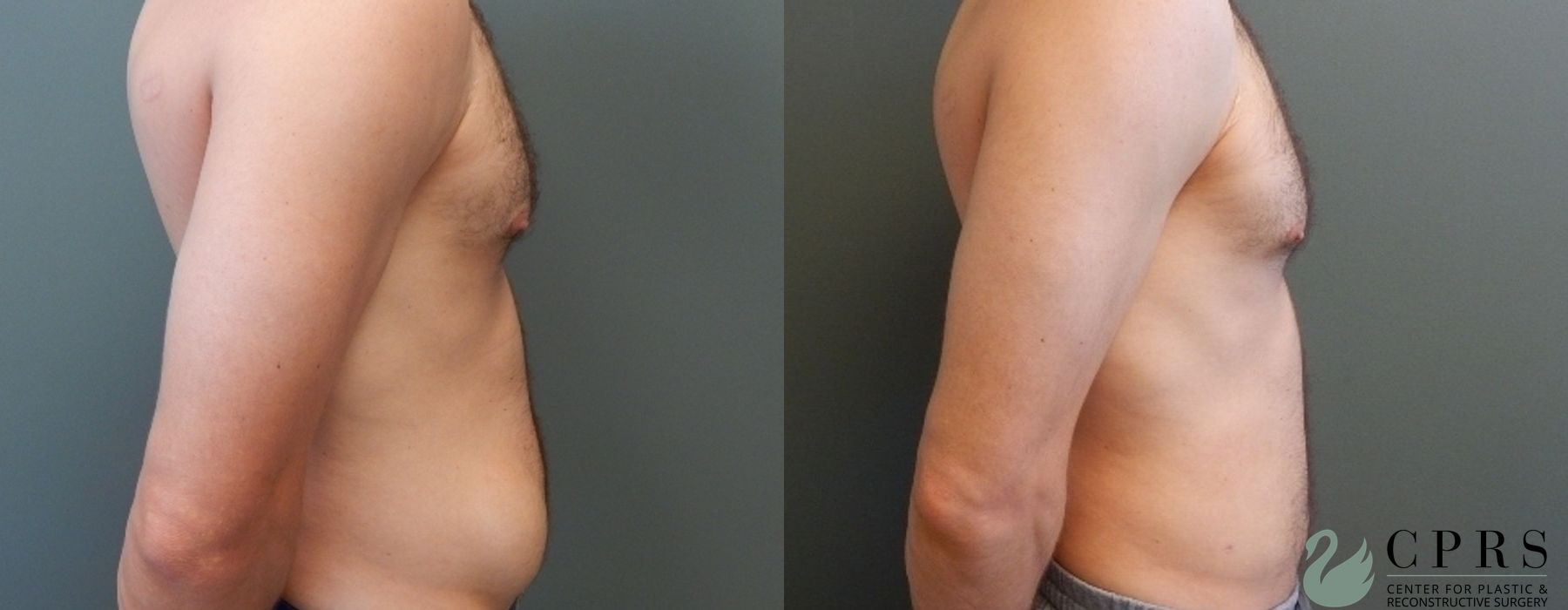 Liposuction - Thumbnail 2