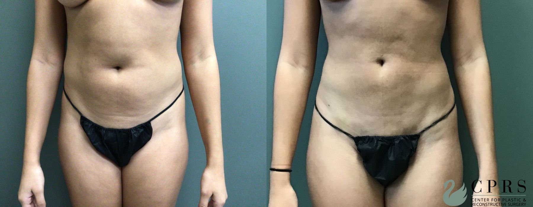 Liposuction - Case 239587