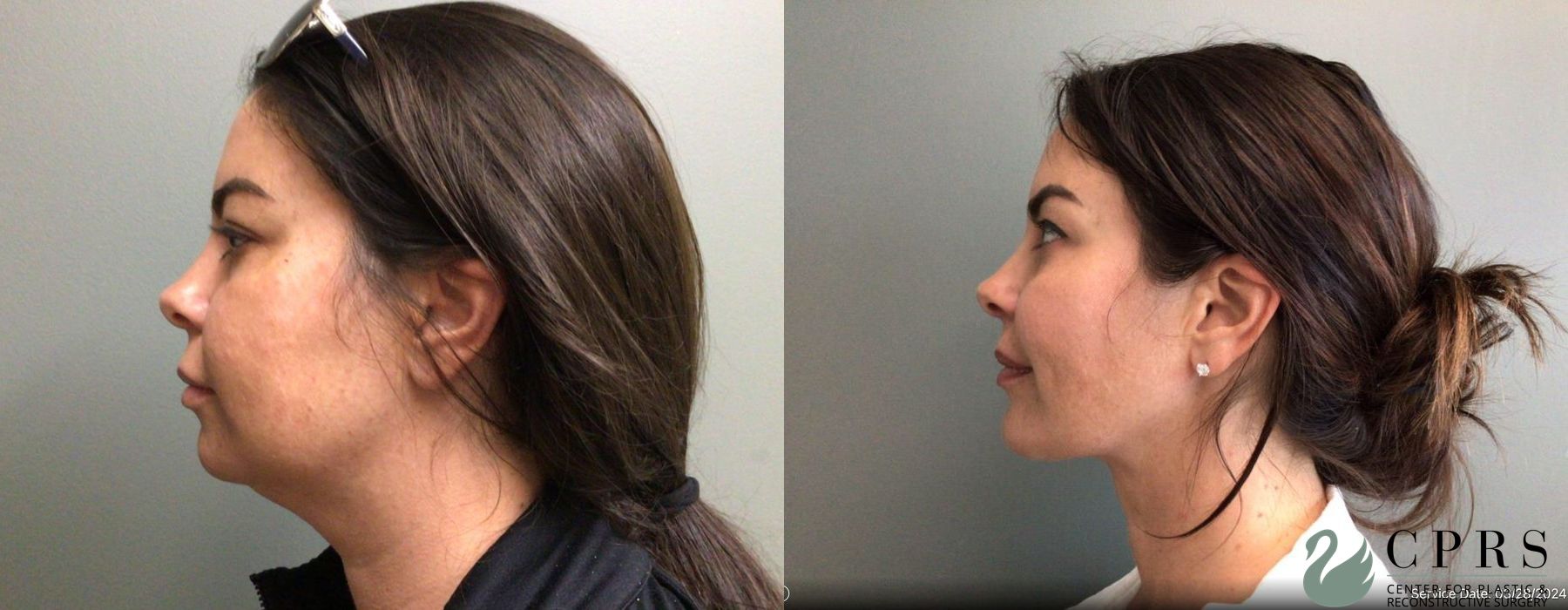 Before and after Liposuction case 19159 - Angle 3