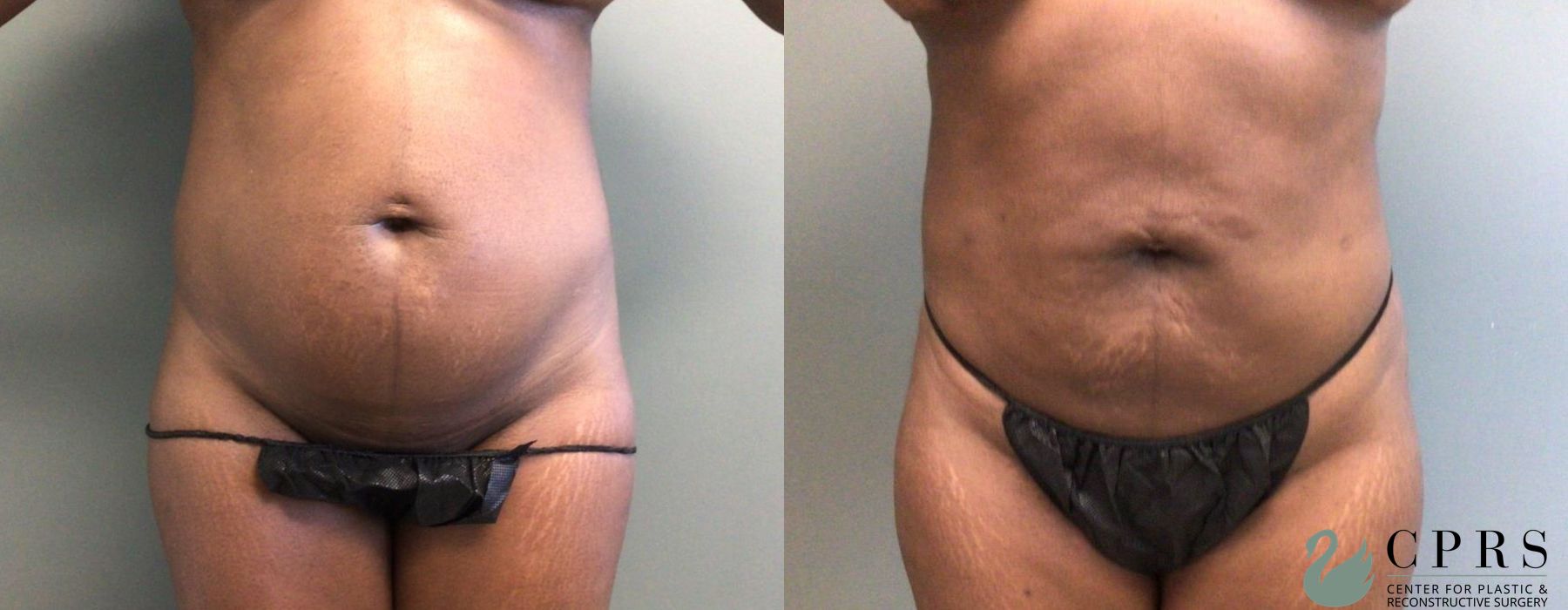 Before and after Liposuction case 19139