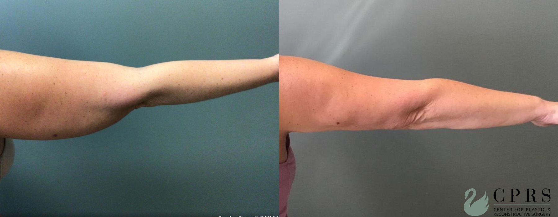 Before and after Liposuction case 19150