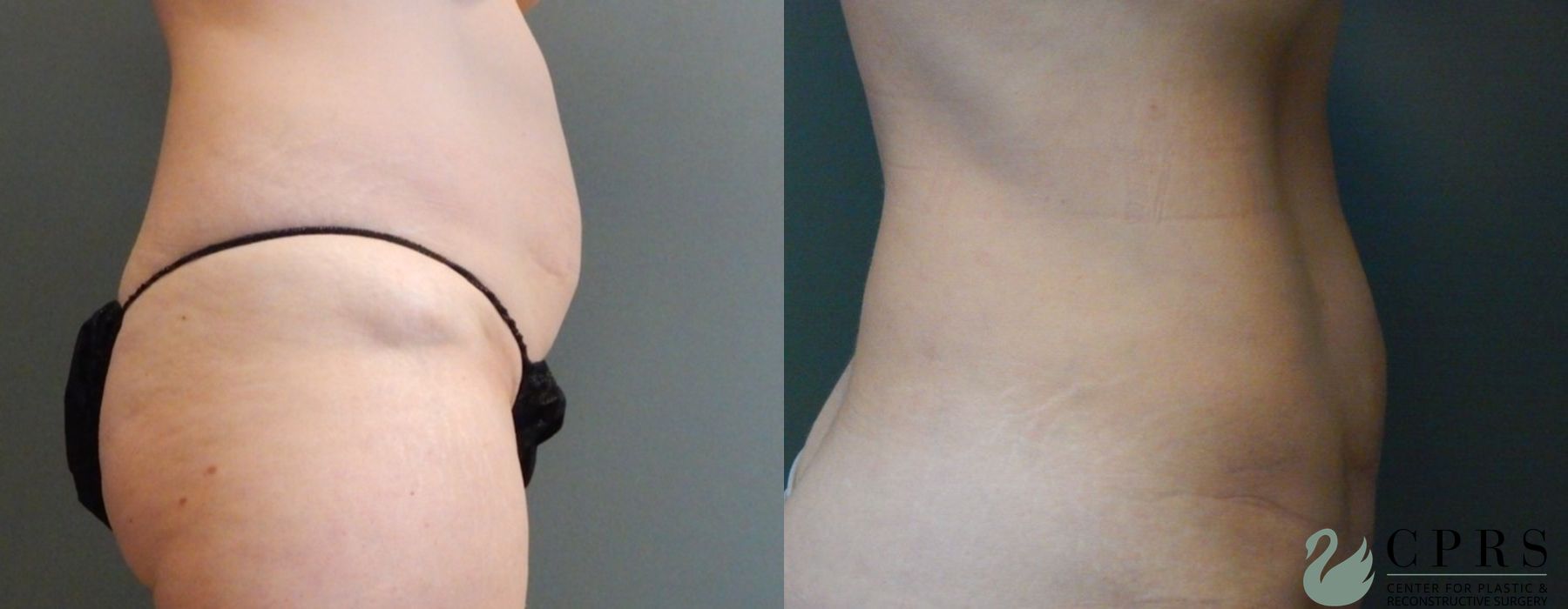 Before and after Liposuction case 19093 - Angle 3