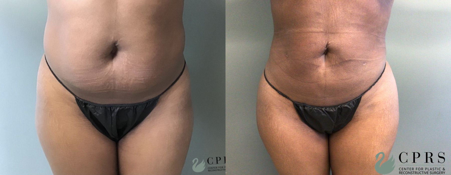 Before and after Liposuction case 19065