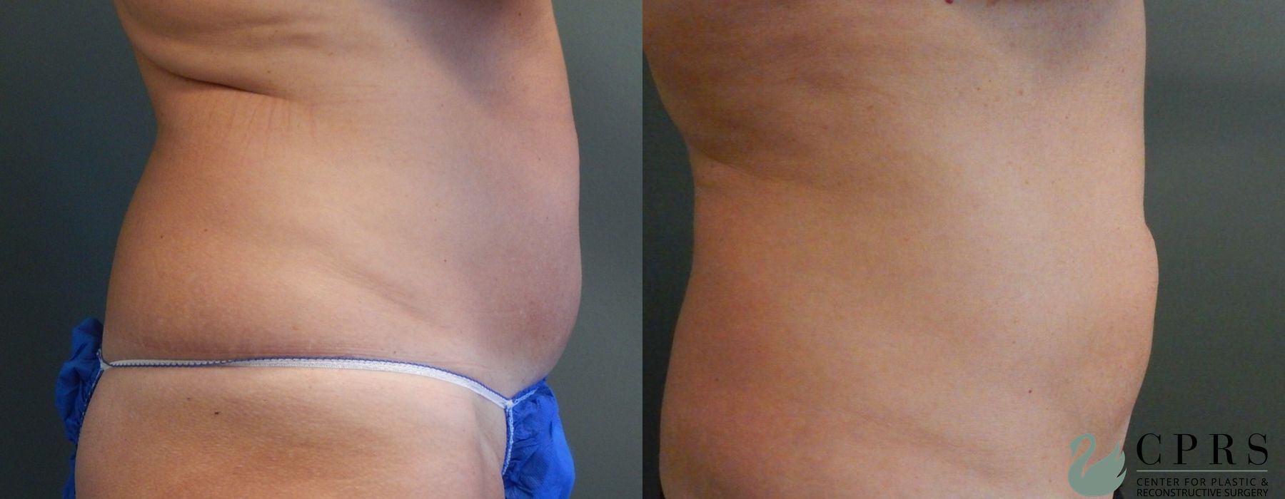 Before and after Liposuction case 18984 - Angle 3