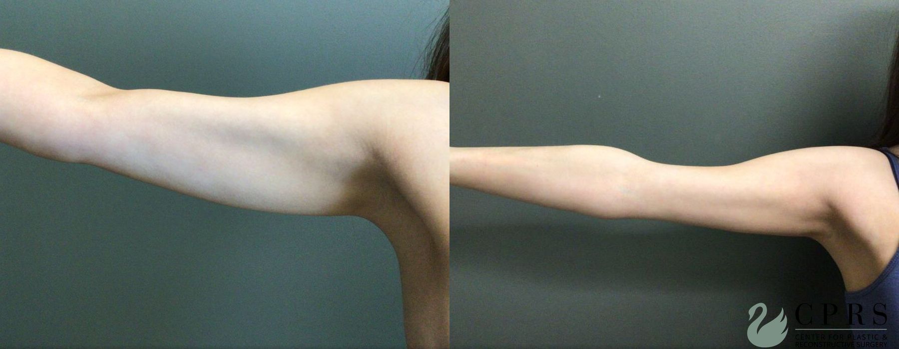 Before and after Liposuction case 19110 - Angle 2