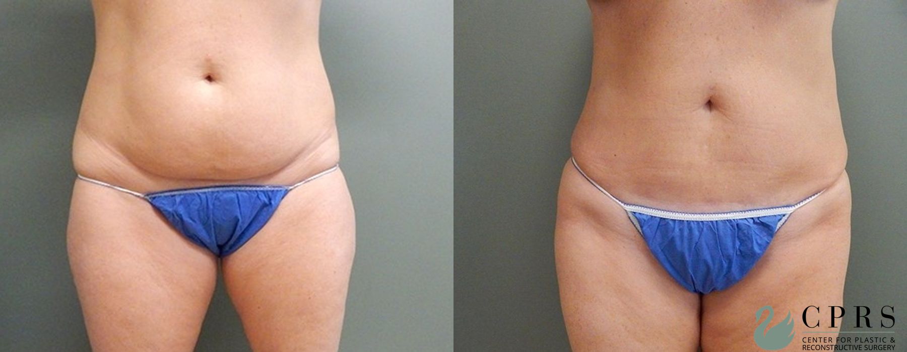 Before and after Liposuction case 18930