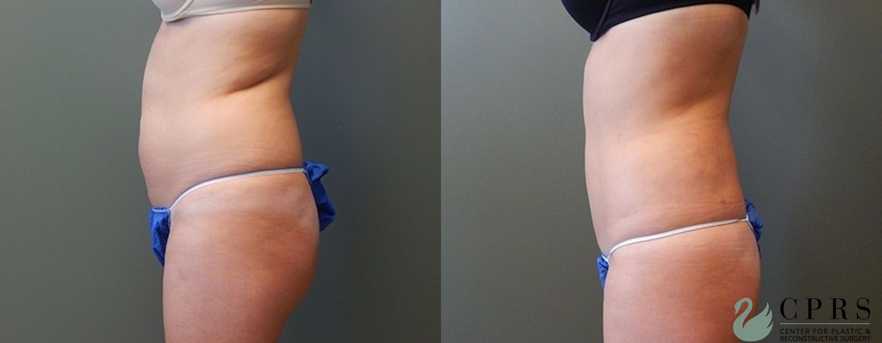 Liposuction - Thumbnail 3