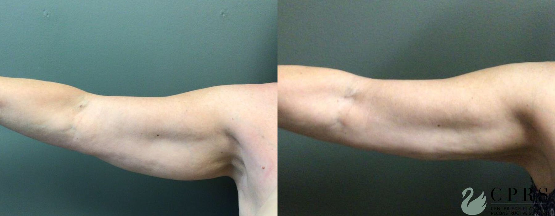 Before and after Liposuction case 19101