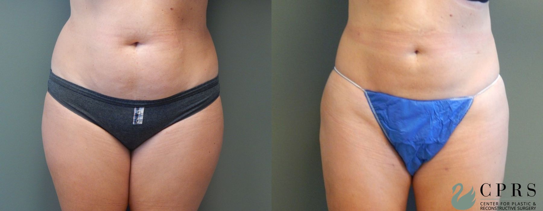 Liposuction - Case 239591