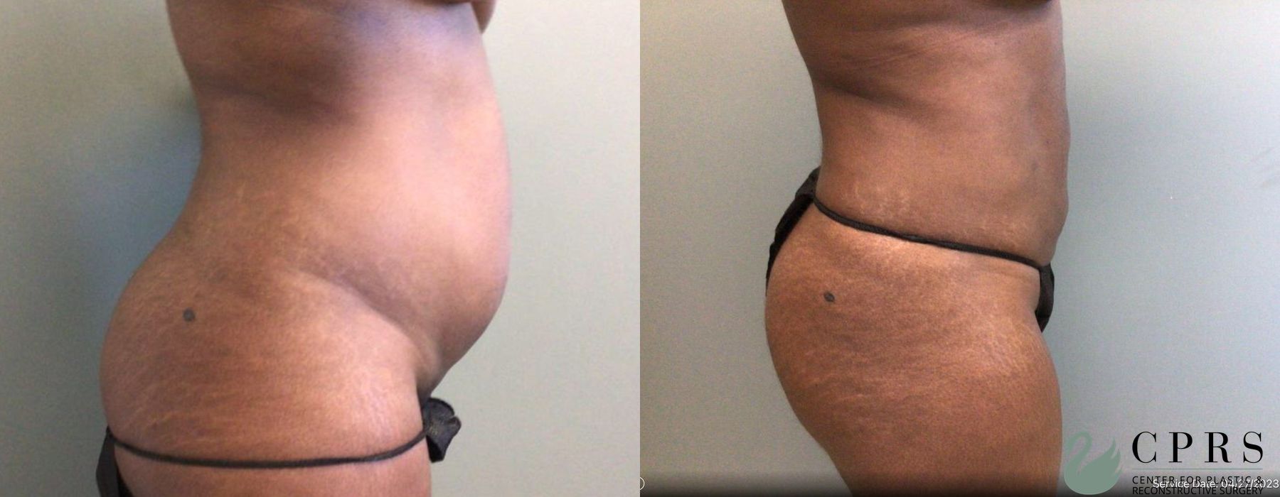 Before and after Liposuction case 19139 - Angle 3