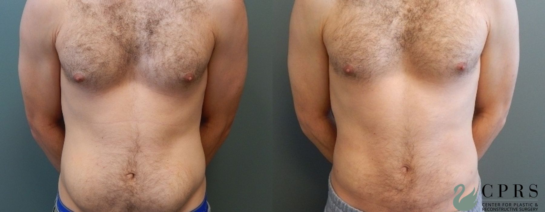 Liposuction - Case 239593