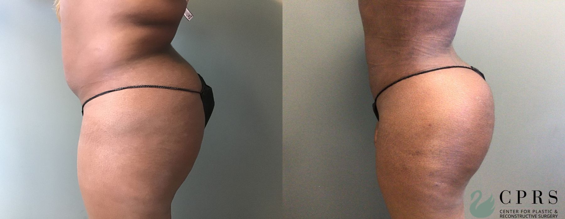 Before and after Liposuction case 19065 - Angle 4