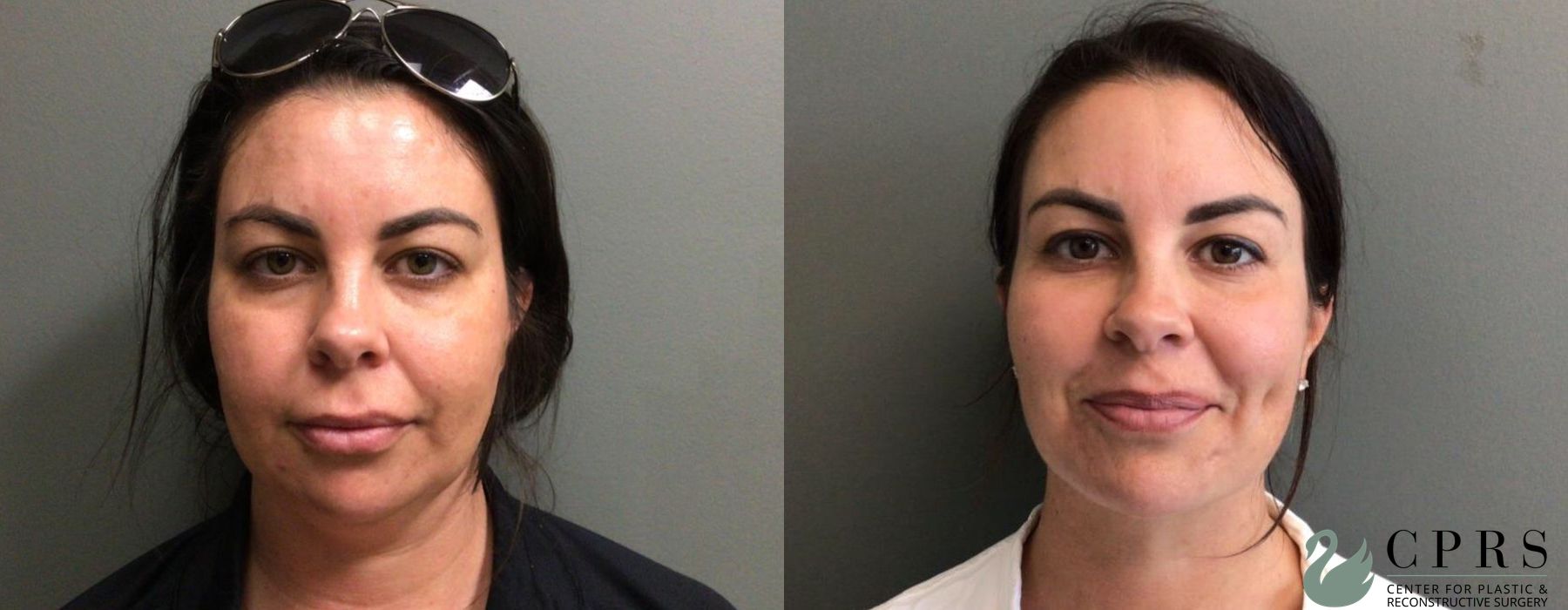 Before and after Liposuction case 19159