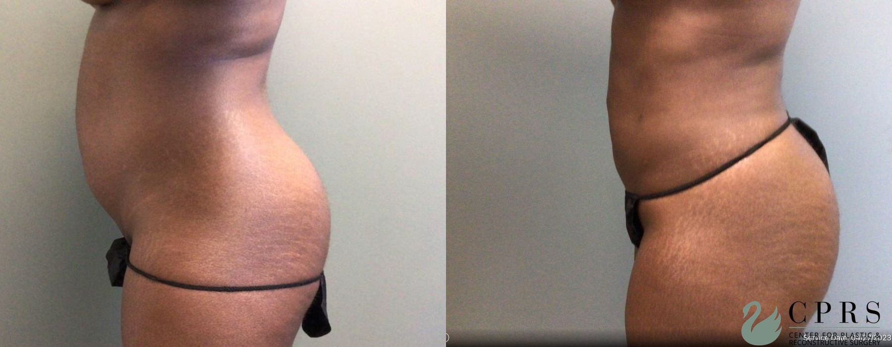 Before and after Liposuction case 19139 - Angle 2