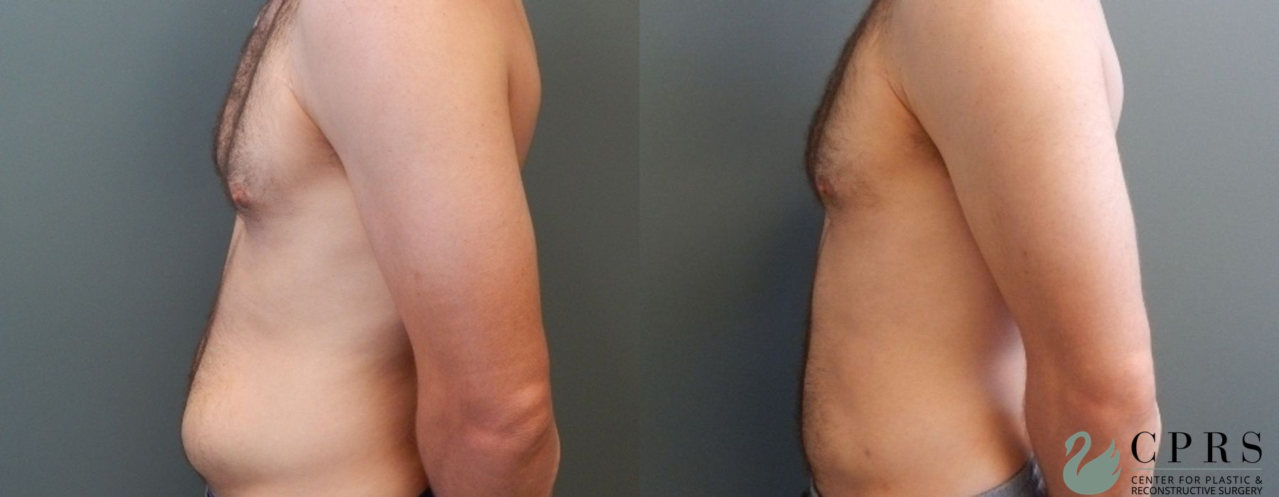 Liposuction - Thumbnail 3