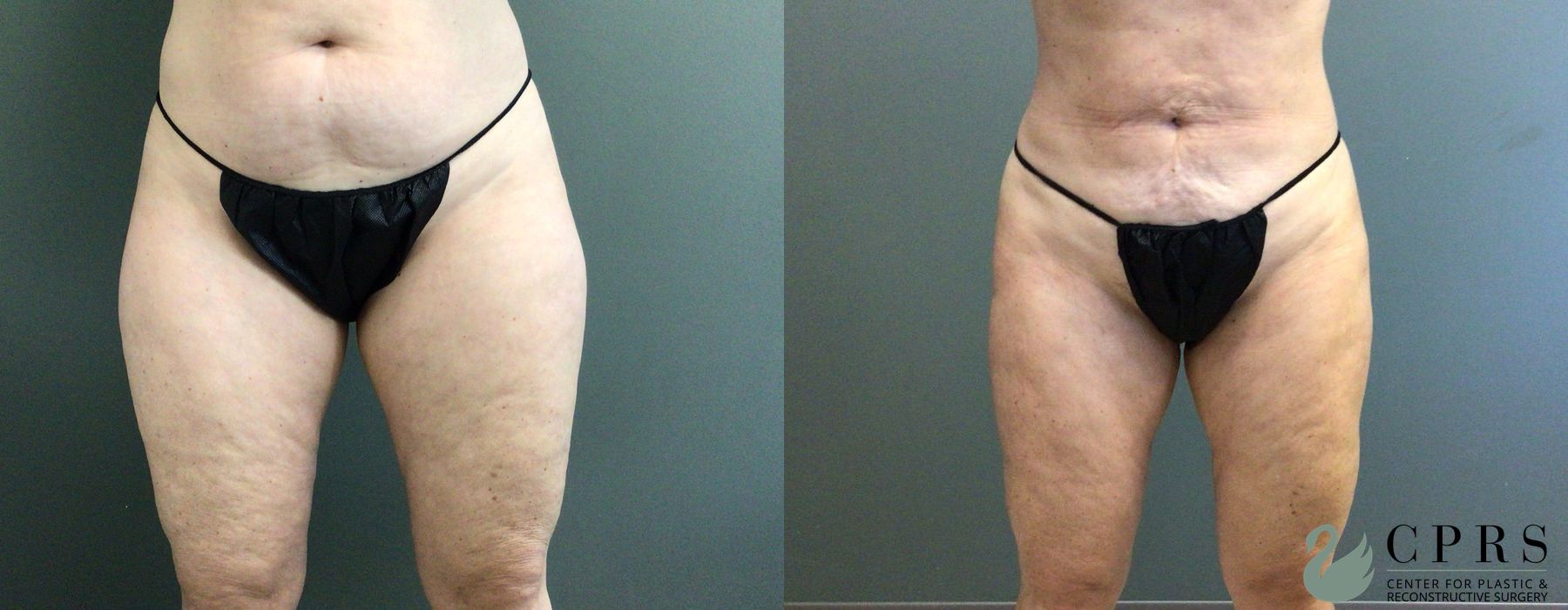 Before and after Liposuction case 33065 - Angle 2