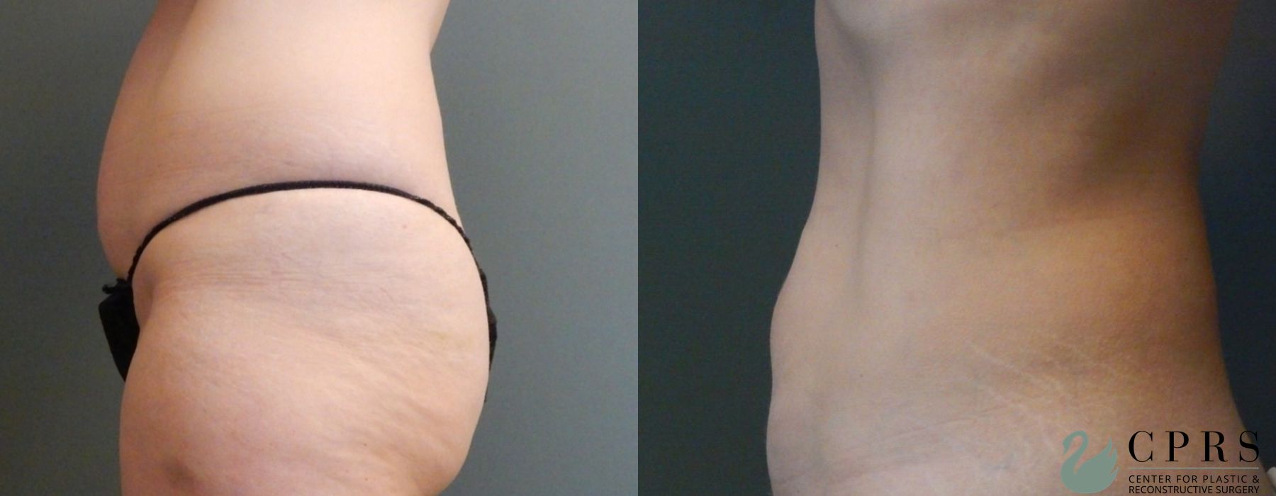 Before and after Liposuction case 19093 - Angle 2