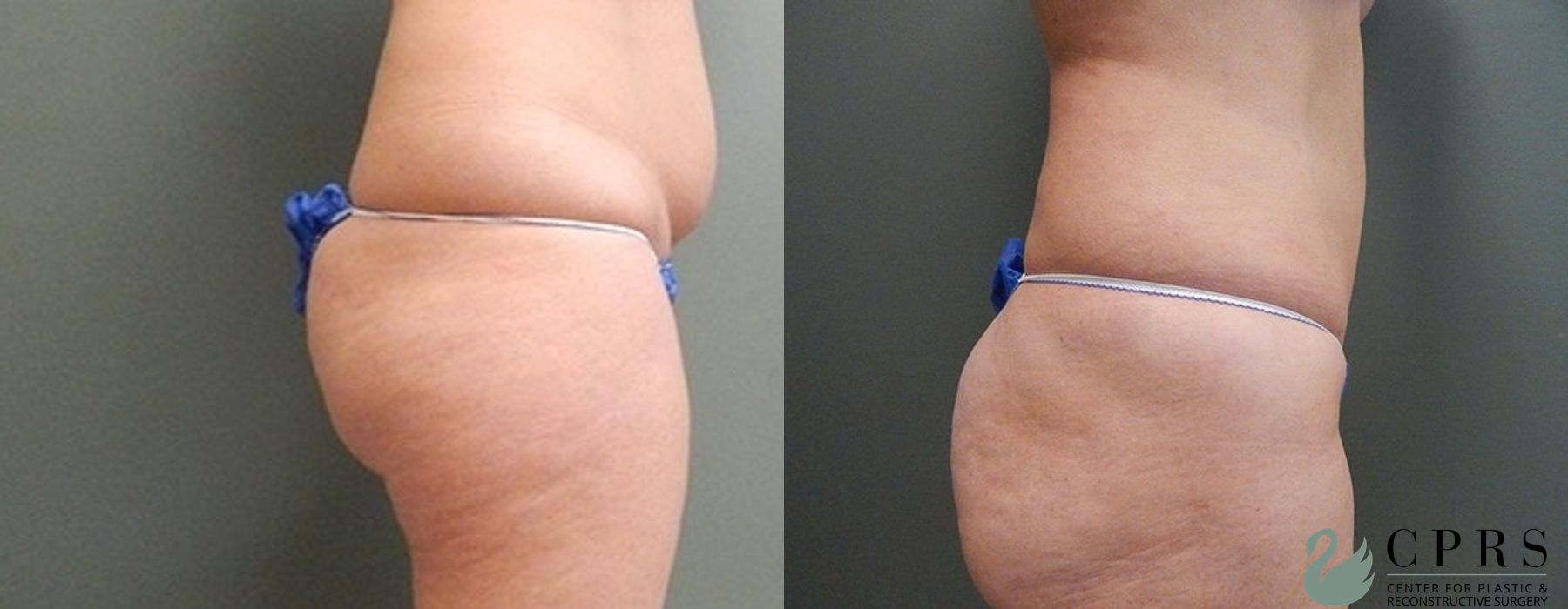 Before and after Liposuction case 18930 - Angle 2