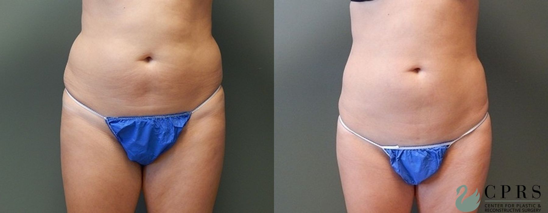 Liposuction - Case 239594