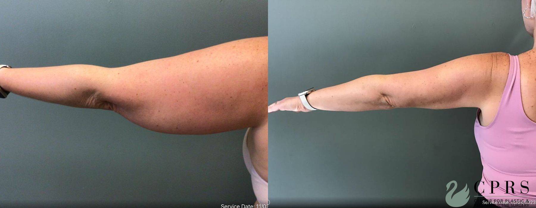 Before and after Liposuction case 19150 - Angle 2