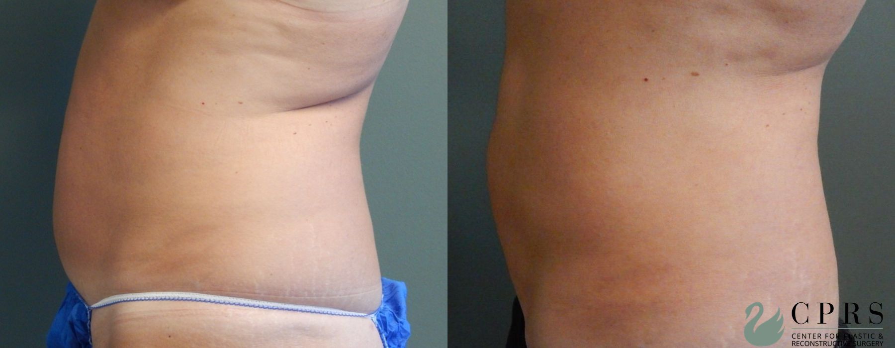 Before and after Liposuction case 18984 - Angle 2