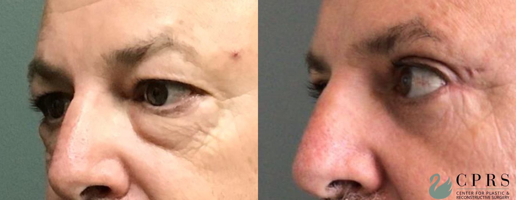 Before and after Male Blepharoplasty case 19118 - Angle 3