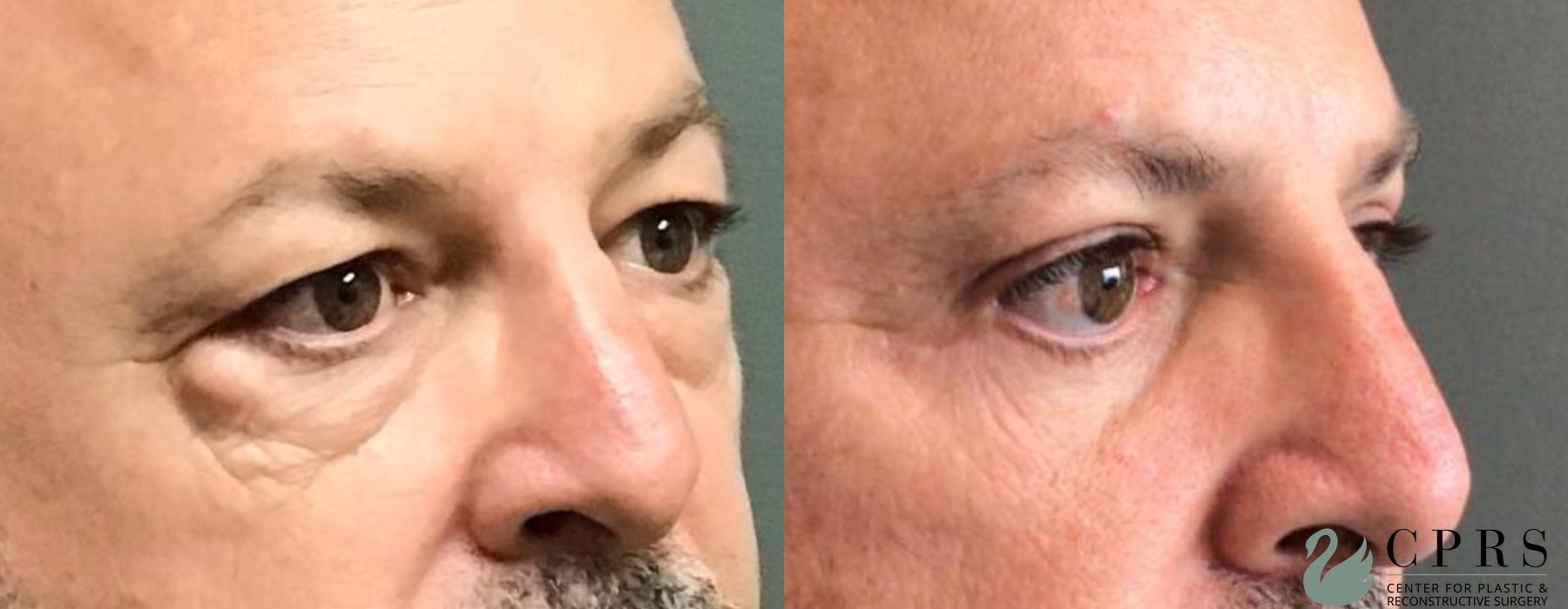 Before and after Male Blepharoplasty case 19118 - Angle 2