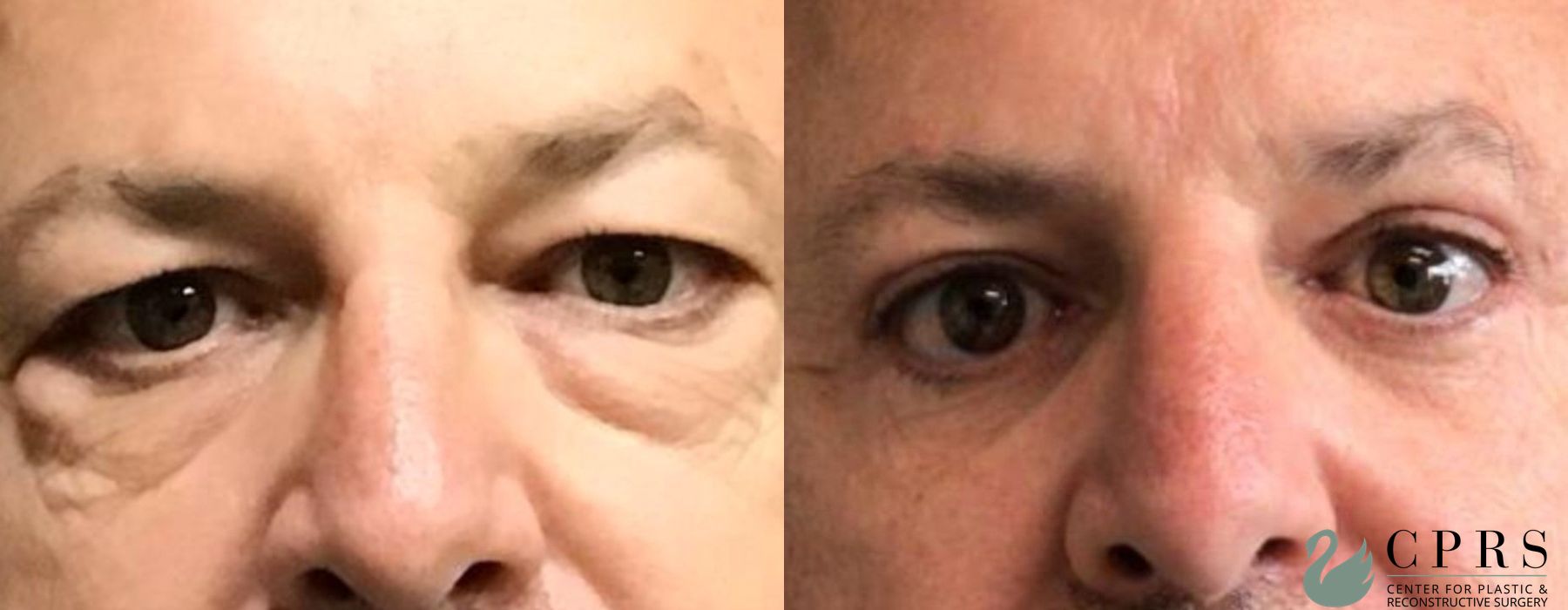 Before and after Male Blepharoplasty case 19118