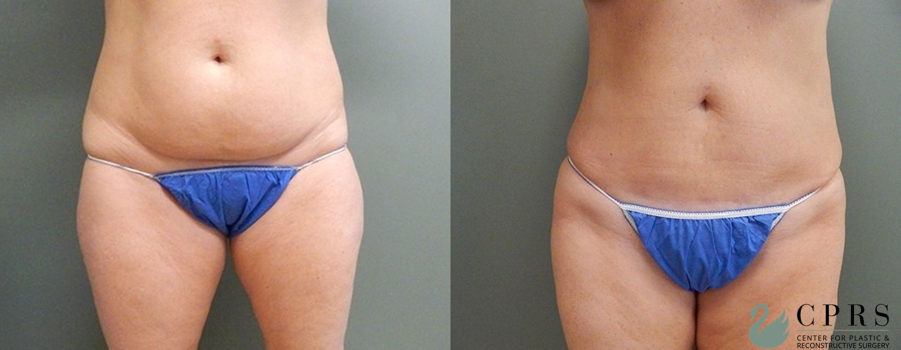 Mini Tummy Tuck - Case 239605
