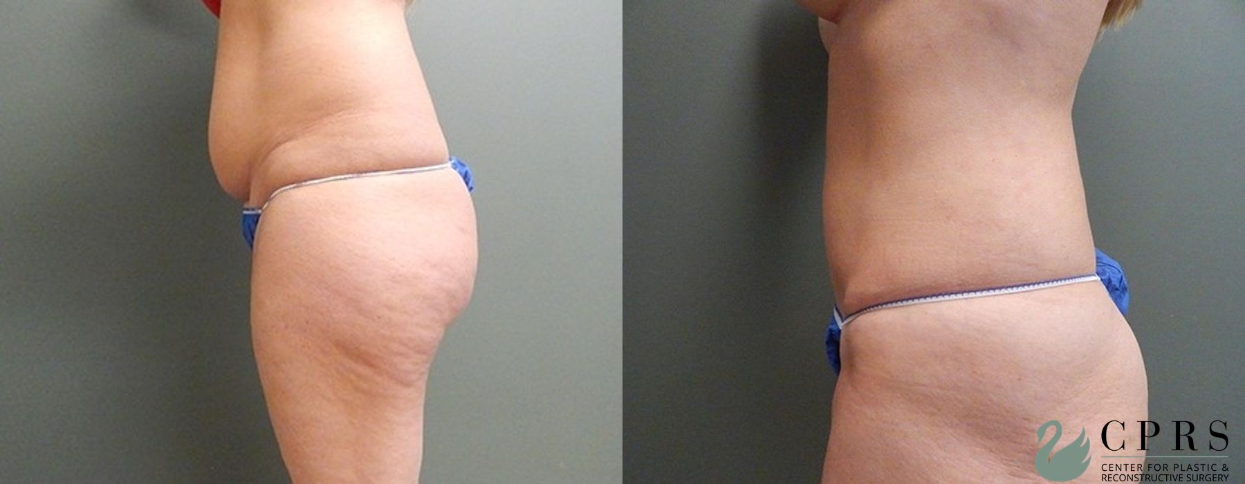 Mini Tummy Tuck - Thumbnail 3