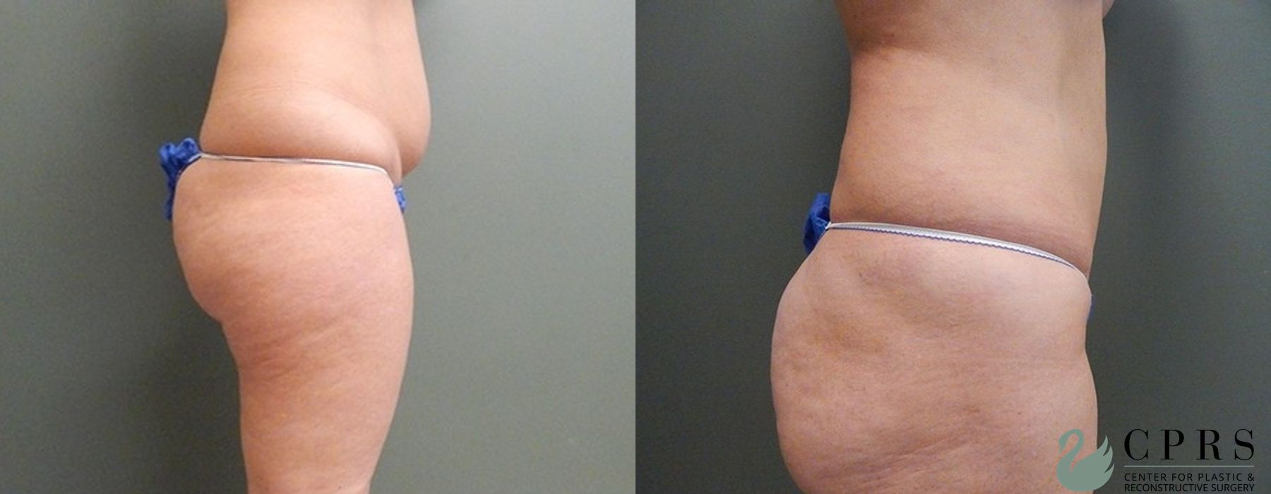 Mini Tummy Tuck - Thumbnail 2