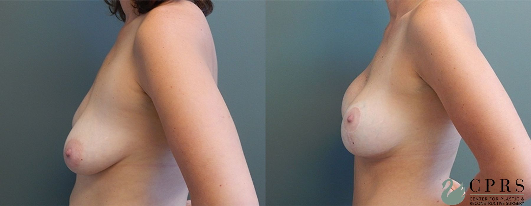 Before and after Mommy Makeover case 18946 - Angle 6