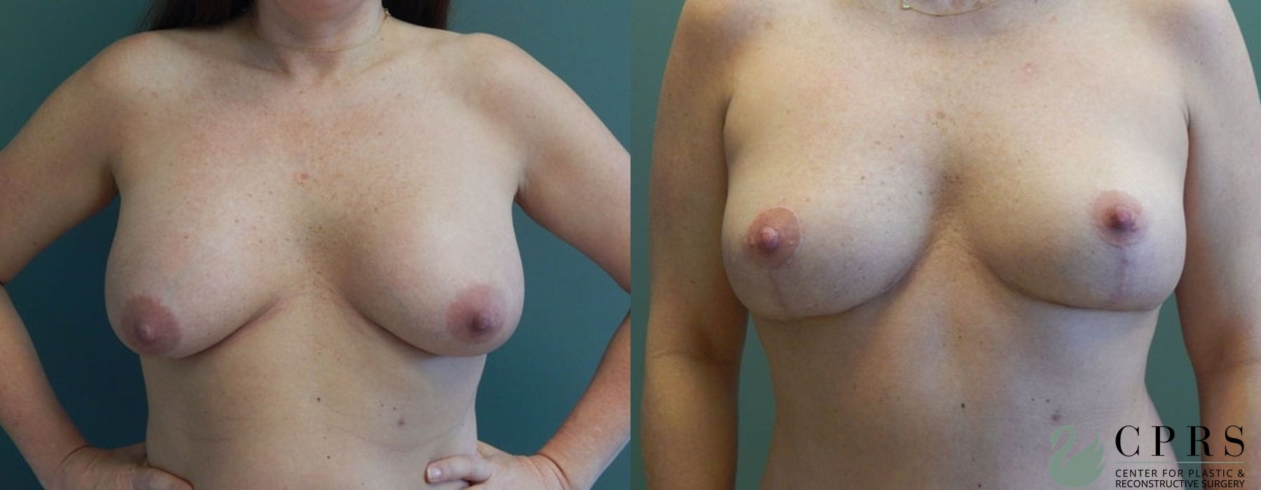 Before and after Mommy Makeover case 18923 - Angle 4