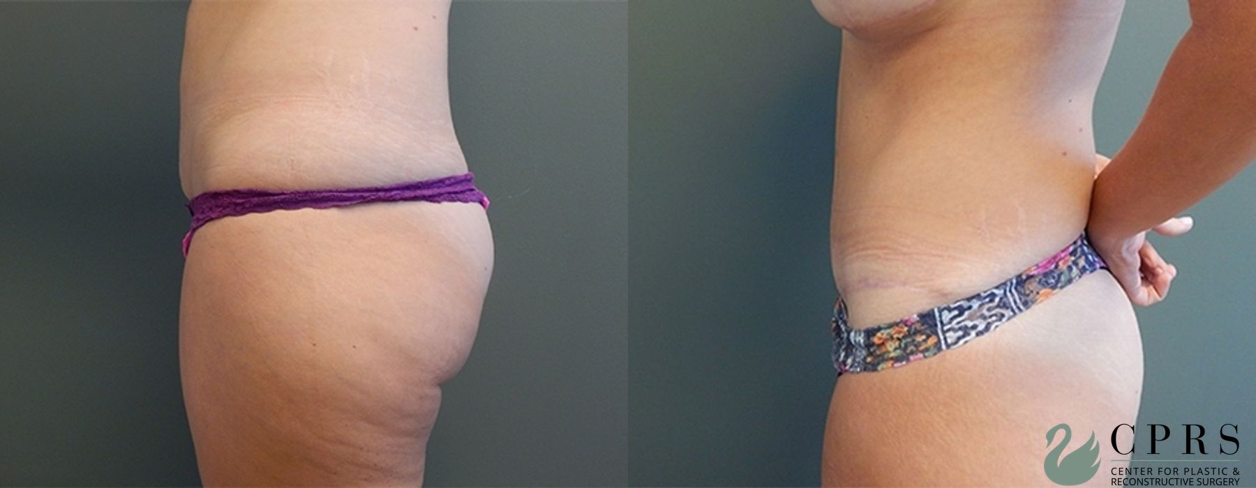 Before and after Mommy Makeover case 18946 - Angle 3