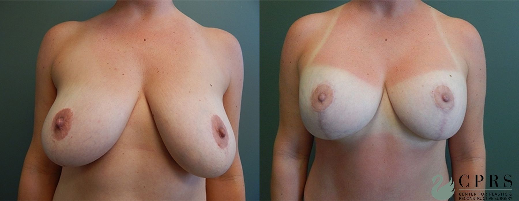 Before and after Mommy Makeover case 18931 - Angle 4