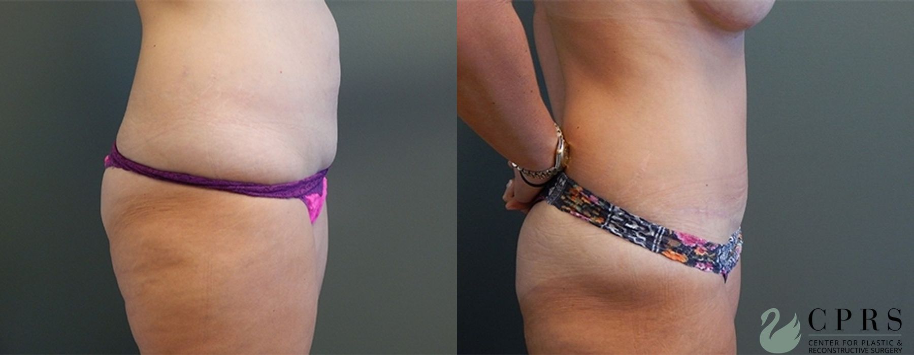 Before and after Mommy Makeover case 18946 - Angle 2