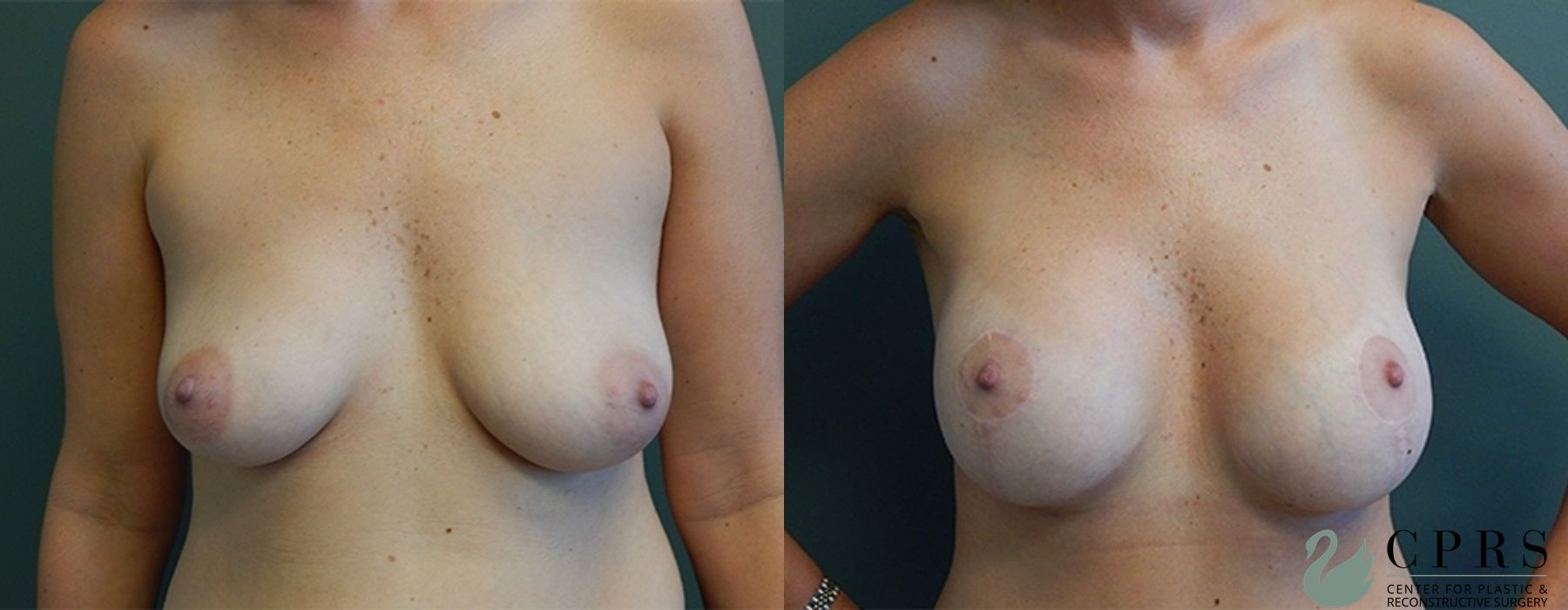 Before and after Mommy Makeover case 18946 - Angle 4