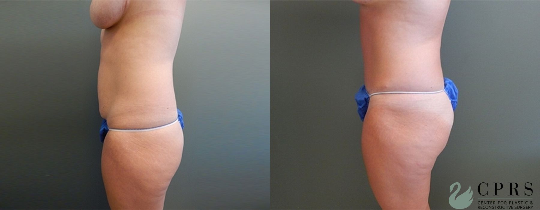 Before and after Mommy Makeover case 18931 - Angle 2