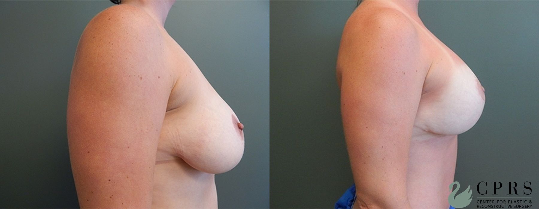 Before and after Mommy Makeover case 18931 - Angle 6
