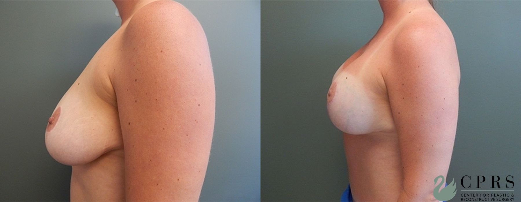 Before and after Mommy Makeover case 18931 - Angle 5